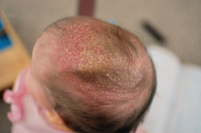 Horrible Cradle Cap